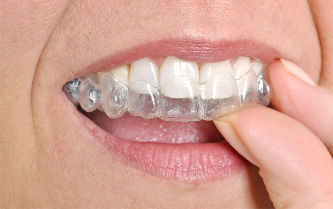 transparent braces